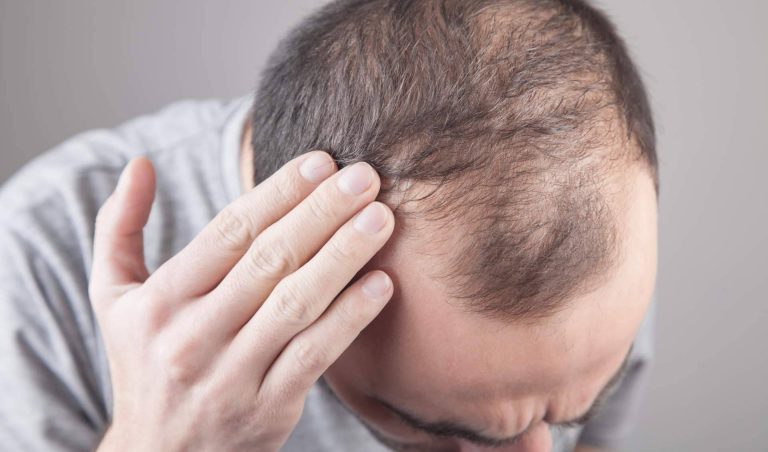 Xpecia Hombre, el aliado nutricional contra la alopecia androgénica disponible en HairFluencer